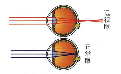 正常眼和远视眼的区别