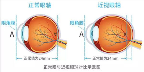 高度近视怎么矫正