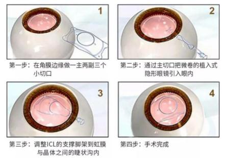 高度近视