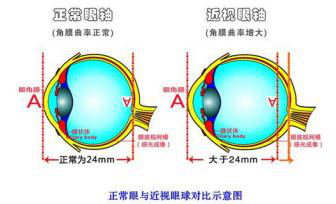 角膜塑形镜适用于多少度数,昆明好的眼科医院