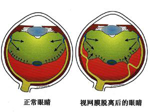 视网膜脱落症状