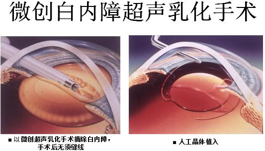 昆明白内障手术