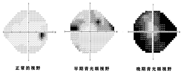 多少度算高度近视