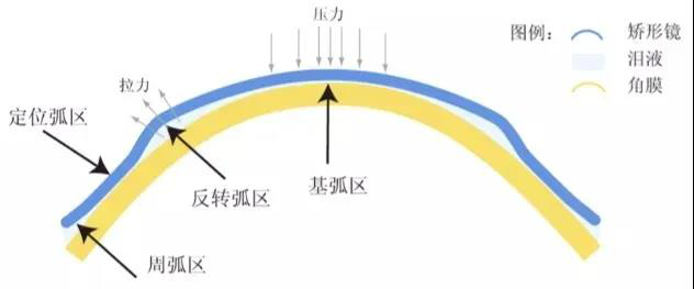 昆明哪家医院可以配角膜塑形镜