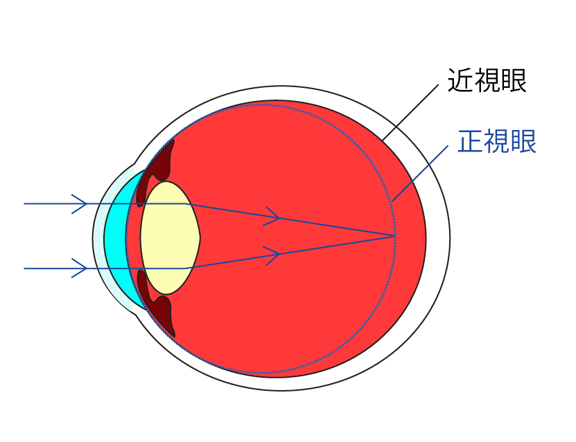 近视手术会视力反弹吗？