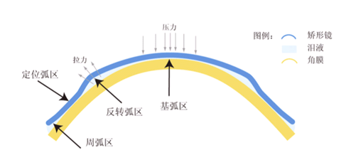 OK镜对眼睛伤害大吗？