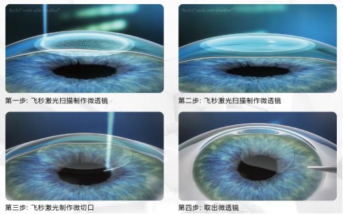 icl手术大概多少钱？