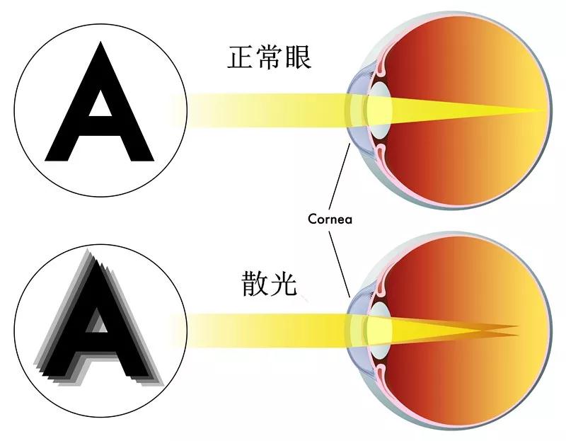 散光能够做近视手术吗？